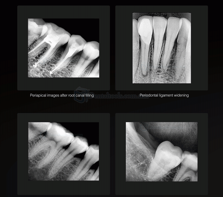 Runyes DR730 Sensor de rayos X dental sensor intraoral digital para dentista